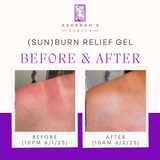Skin Care - (Sun)Burn Relief